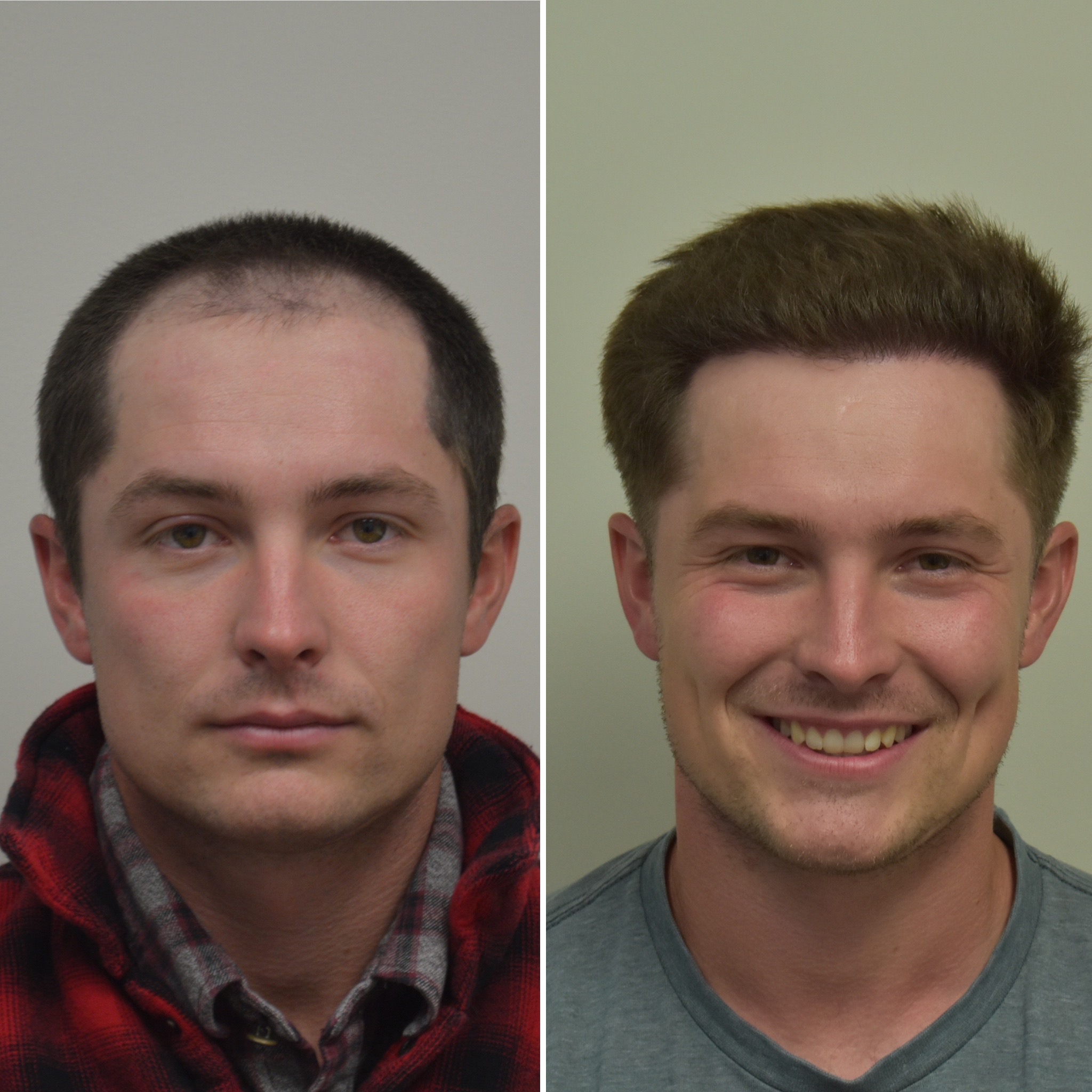 LA FUE Hair Clinic - Los Angeles FUE Hair Transplant Clinic
