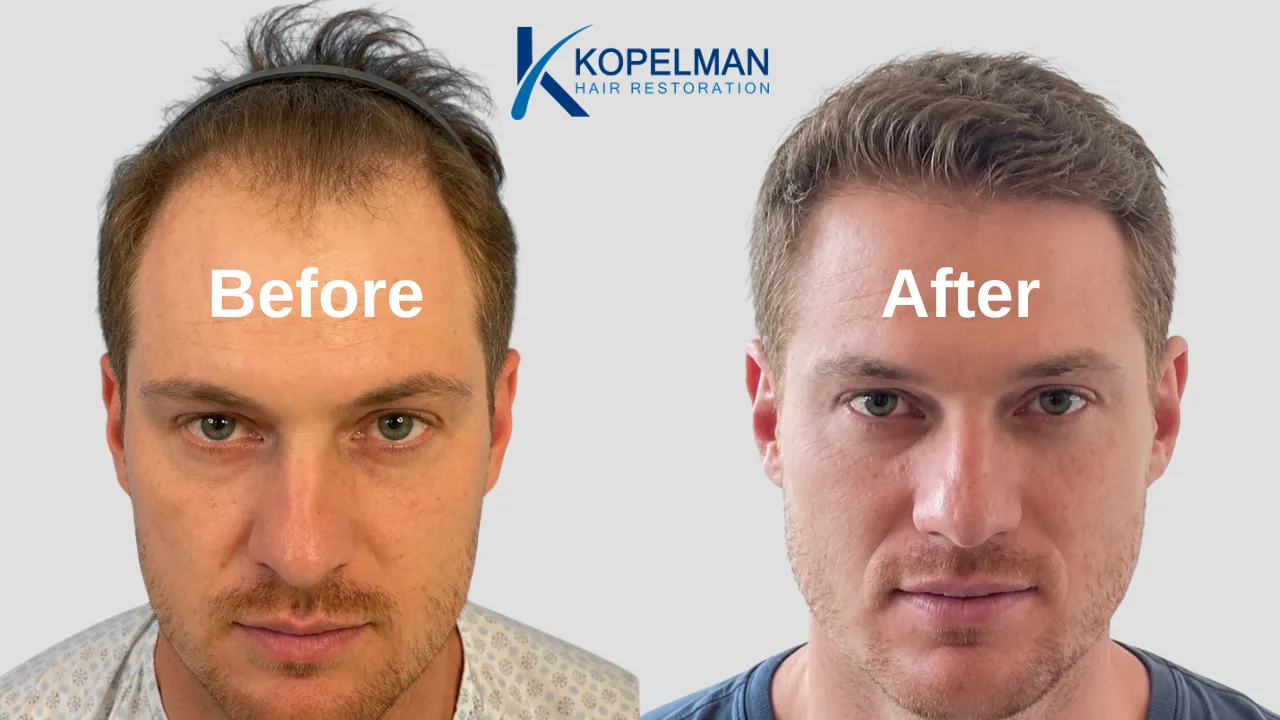 Kopelman Hair Restoration NYC: Hair Transplant Clinic