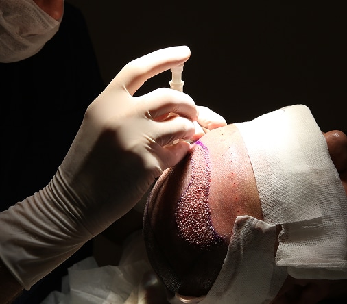 McBeth Elliott Hair - Transplant & Restoration - Beverly Hills
